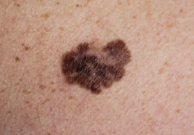 A melanoma on human skin. A melanoma on human skin.